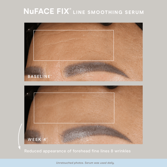 DISCONTINUED - NuFACE FIX® Starter Kit | NuFACE