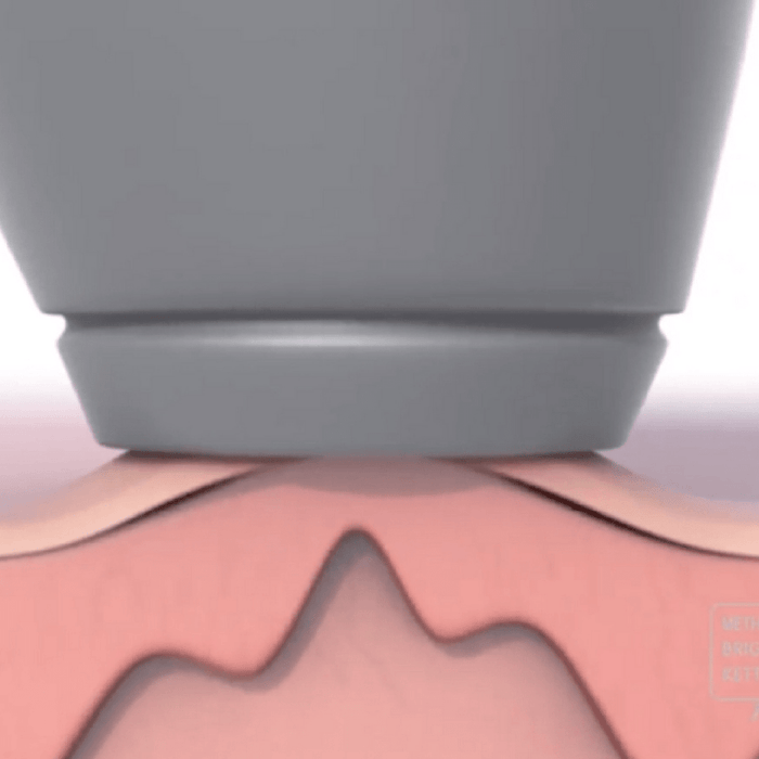 DISCONTINUED -MBK Microdermabrasion Replacement Tips | MBK Skincare